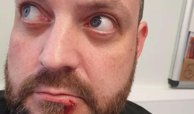 Fringe comedian punched by audience member | Colin Higgins needed stitches after woman's attack